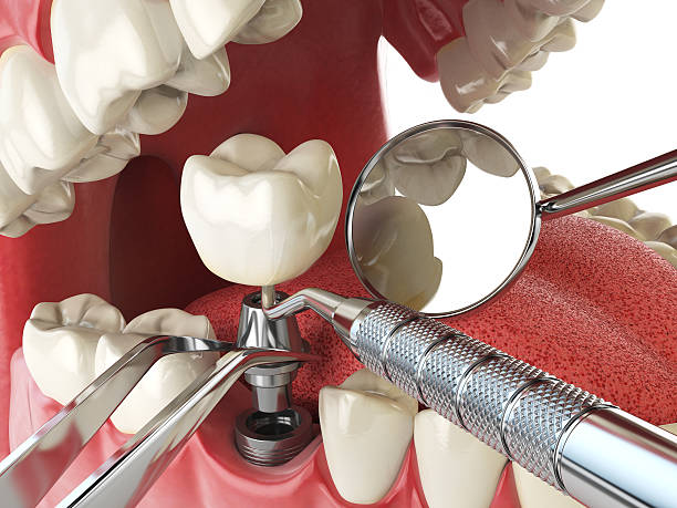 Best Emergency Dental Filling Replacement  in Laware City, DE